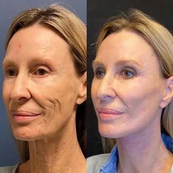 REAFIRMA Y REDUCE TU PAPADA Y ARRUGAS - Serum Botox con Colageno🪞🌿