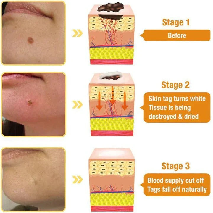 TAG RECEDE ✨ Elimina Manchas y Verrugas SIN Dolor – Ideal para Piel Sensible ✨ ¡PAGA 1 LLEVA 2!👇